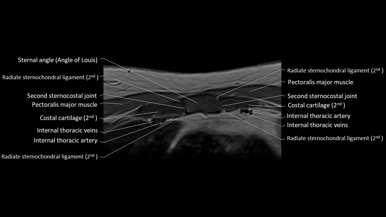 MRI sternum and sternoclavicular joint labeled axial anatomy image 13.webp